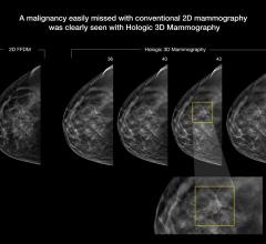 digital breast tomosynthesis, ECRI Institute, technology forecast report