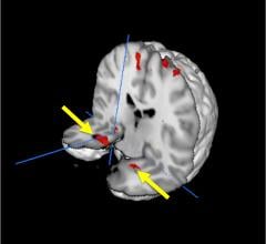 brain scans, nightmare flight, trauma memory, Baycrest, Daniela Palombo