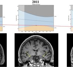 Reduced hippocampal volume on MRI