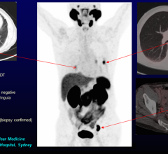 A 77-year-old male with recurrent lymph node and pulmonary metastases detected by Ga-68 PSMA PET/CT but not by conventional imaging