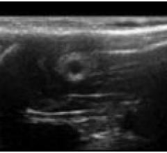 Ultrasound chitosan nerve conduit rat model sciatic nerve defects 