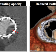 Edwards Completes Enrollment in PARTNER 3 Low-Risk CT Sub-Study