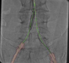 An example of Vessel Assist used to create vessel centerlines through a CTO to help guide revascularization in the cath lab.