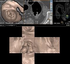 ACR, USPSTF recommendations, CT colonography, colorectal cancer screening