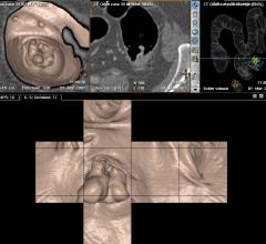 virtual colonoscopy, ACR, Medicare coverage, colorectal cancer screening, CRC