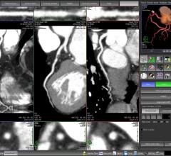 coronary CT angiography, CCTA, CAD, coronary artery disease, alcohol consumption, RSNA 2016