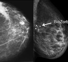 Research Shows Breast Cancer Surgery Marker Associated With Smaller Radiation Volume