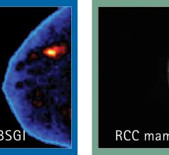 Molecular Breast Imaging Mammography Women's Health 