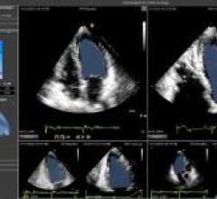 Epsilon Imaging, EchoInsight, ASE 2015, cardiac ultrasound image analysis