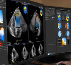 Epsilon Imaging EchoInsight Cardio Oncology Echo Cardiac Ultrasound 