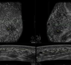 luminal A subtype breast cancer, hormone, radiation, Princess Margaret