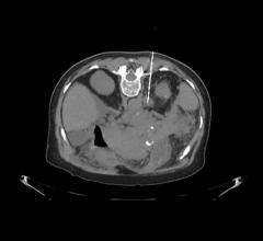 Southwest Diagnostic Imaging Center (SWDIC), Dallas, Revolution GSI, CT, dual energy