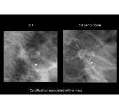 GE Healthcare, Senoclaire, 3-D tomosynthesis mammography system, FDA approval