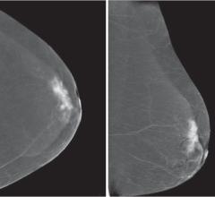 Medicaid expansion, breast cancer screening, low-income women, study, RSNA 2015