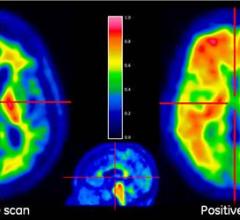 Alzheimer's, tau PET tracers, positron emission tomography, dementia, research