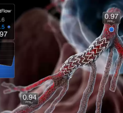 HeartFlow Enters into Licensing Agreement with Cedars-Sinai for Coronary Plaque Assessment Technology