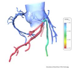 HeartFlow, FFR-CT, ruptured coronary plaques, EMERALD study, EuroPCR 2016