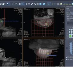 Sentinelle Aegis Offers Real-Time MRI Breast Interventional Guidance