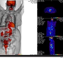 SNMMI Publishes New FDG PET/CT Appropriate Use Criteria