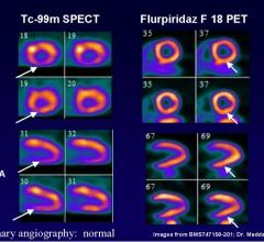 Lantheus, flurpiridaz F 18, ICNC12, SPECT, CAD, PET, MPI, myocardial perfusion