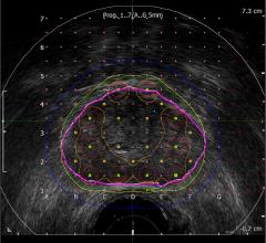 MIM Software, BK Ultrasound, bkFusion, MRI Fusion Biopsy System, prostate cancer, RSNA 2016