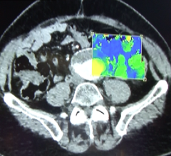 Philips, RSNA 2016, IQon spectral CT