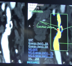 Navidea, Mass General, Tc99m-tilmanocept, vulnerable plaque, cardiovascular disease, Harvard