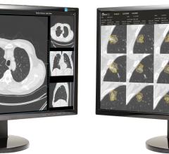 Third Annual Data Science Bowl Winners Advance Low-Dose CT Lung Cancer Screening