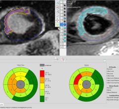 Pie Medical Imaging, CAAS MRV, MRI, cardiac perfusion