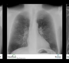 Riverain Technologies, ClearRead Bone Suppression, ClearRead Confirm, UCHealth, University of Colorado, chest X-ray, lung cancer detection