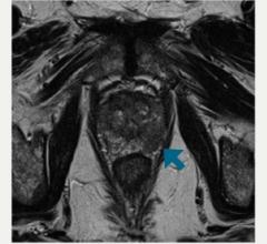 MRI, prostate cancer, zinc, UT Southwestern Medical Center study