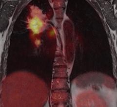 Median Technologies and the Nice University Hospital to Use AI in Lung Cancer Screening