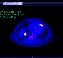 Medraysintell, nuclear medicine, World Market Report, radiopharmaceuticals