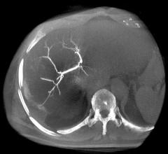 CT angiography, CCTA, arterial plaque, calcification, calcium scoring