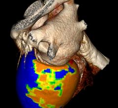 Vital Images, Toshiba, CT Myocardial Perfusion, cardiac CT, CORE 320 study