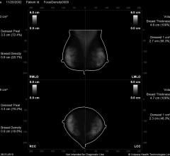 Volpara, Density Maps, breast density measurement, FDA clearance