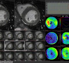 RSNA 2016, short-term sleep deprivation effects, heart function, clinical study, cardiac magnetic resonance, CMR strain analysis