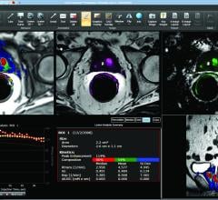 Netherlands Cancer Institute Exploring Molecular Imaging Technology for Prostate Cancer Surgery