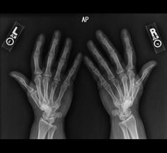 RSNA Announces Pediatric Bone Age Machine Learning Challenge