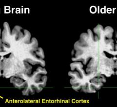 The yellow in the anterolateral entorhinal cortex of the young brain indicates significant activity, something that is absent in the older brain.