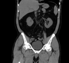 University of California Study Searches for Consistent CT Dose Best Practices