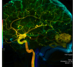 AngioViz uses peak time and density with color as time, and peak density as brig