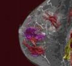 3T MRI Detects "Early" Breast Cancer Not Seen On Mammography, Ultrasound