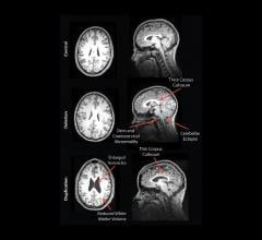 MRI Reveals Striking Brain Differences in People with Genetic Autism