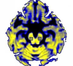 NIH-funded scientists have discovered that Parkinson’s disease increases the amount of “free” water in a particular brain area