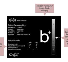 iCAD Featured New Technology for Automated Breast Density Assessment and Showcased Solutions for Tomosynthesis at RSNA 2015