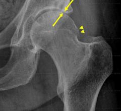 Hip Steroid Injections Associated with Bone Changes