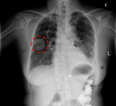 NIH Clinical Center Releases 100,000-Plus Chest X-ray Datasets to Scientific Community