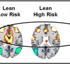 fMRI Study Suggets Childhood Obesity Could Be a Psychological Disorder