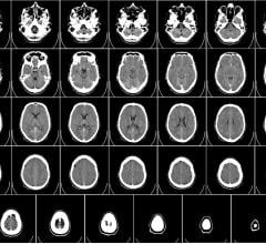 computed tomography brain scan